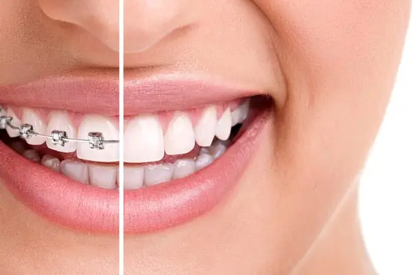 Braces